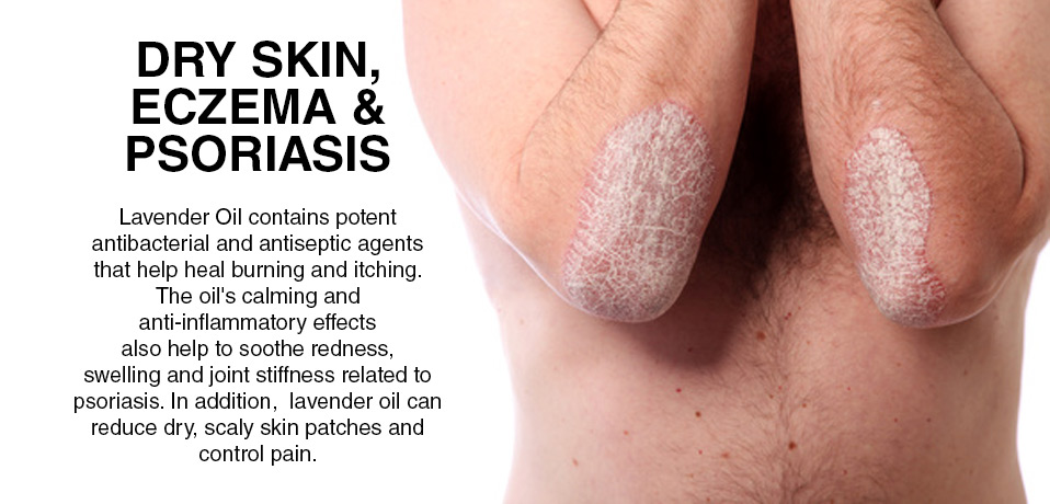 dry skin, eczema and psoriasis relief